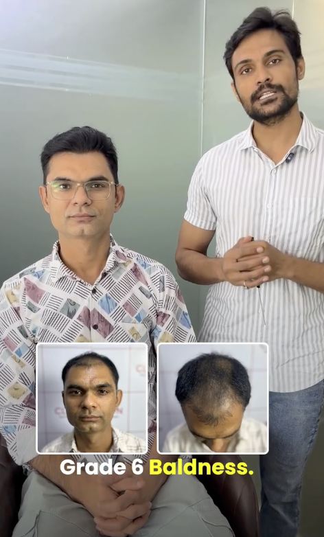 Hair Transplant Before and After Result 1