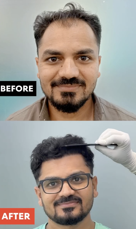 Hair Transplant Before and After Result 2