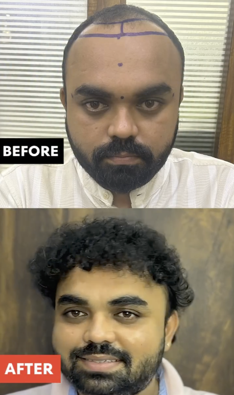Hair Transplant Before and After Result 4