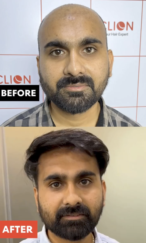 Hair Transplant Before and After Result 5