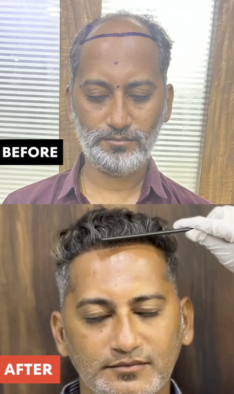 Hair Transplant Before and After Result 6